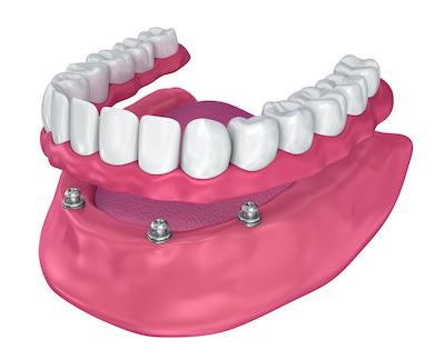 close up of mouth model | 2nd opinion dentist