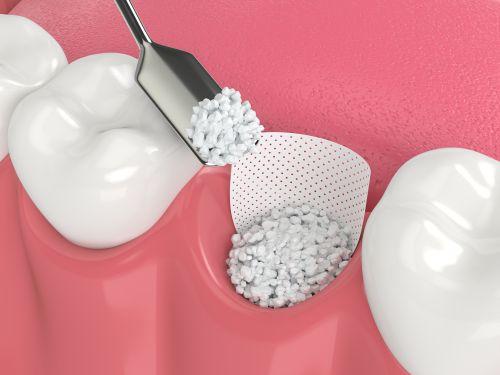 tool completing bone grafting procedure | bone grafting medina oh