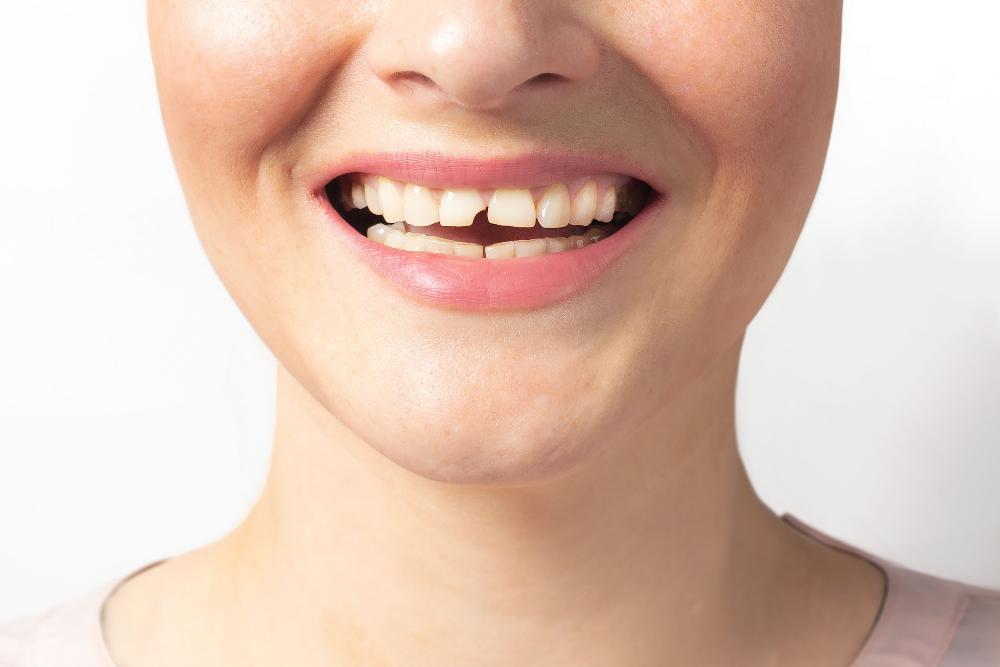 patient with missing chipped front tooth | prosthodontist medina oh