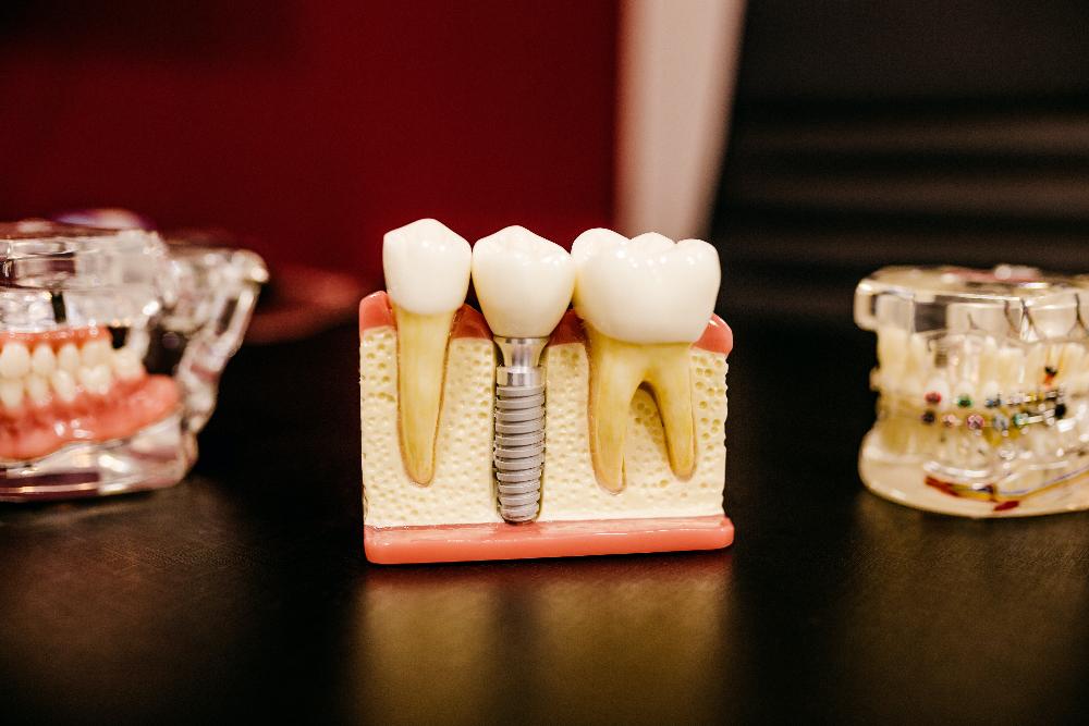 dental implant in lower mouth mold | dental implants medina oh