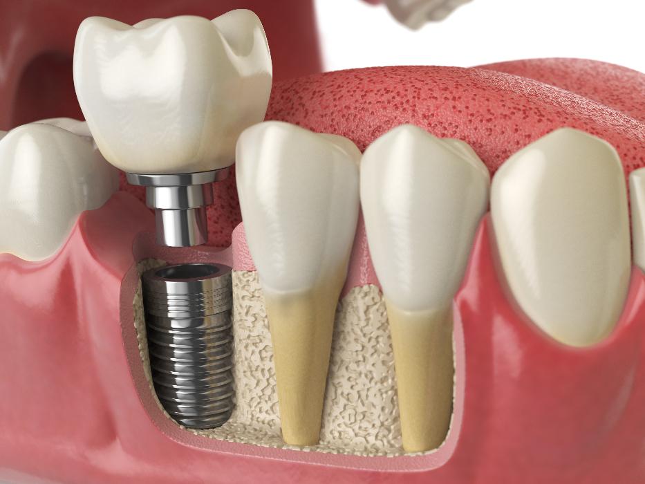 close up of single tooth implant in jaw | tooth implant medina oh