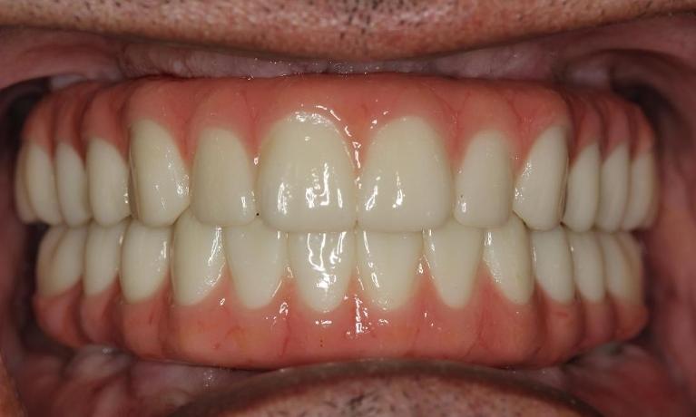 Smile After Dental Implants | Dental Implants Medina OH