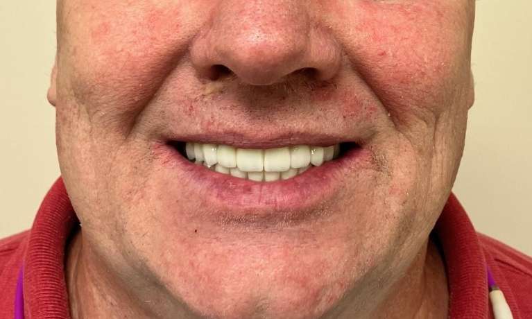 complete smile after dental implants | medina ohio dentist