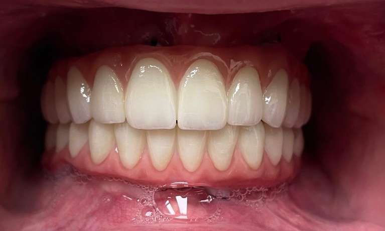 complete smile after dental treatment | medina oh dentist