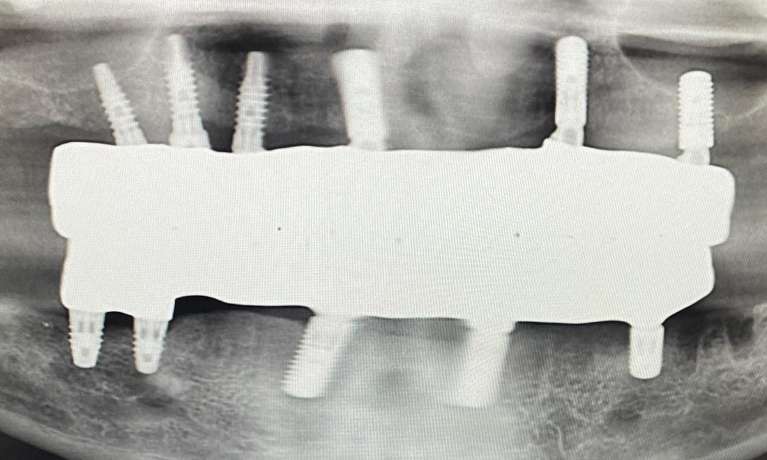 digital x-ray of mouth | dental implants medina oh